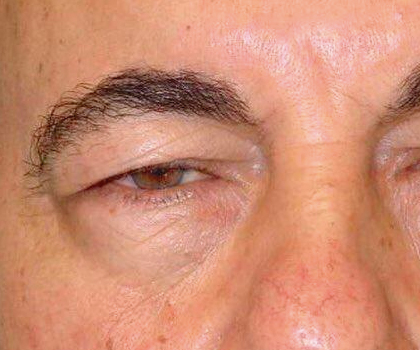 Blefaroplastia funcional