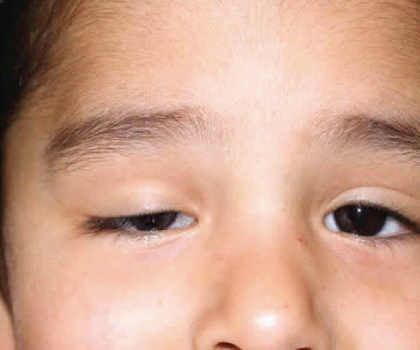 Ptosis palpebral